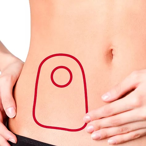 DPE/RN apura situação da fila de espera para cirurgias de reversão de colostomia e assistência a pacientes ostomizados